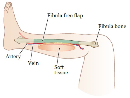 Mandibulectomy Fig 1 En