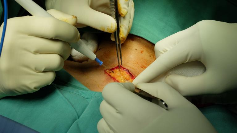 Thyroid,skin,incision,in,throidectomy,surgery.,step,by,step.