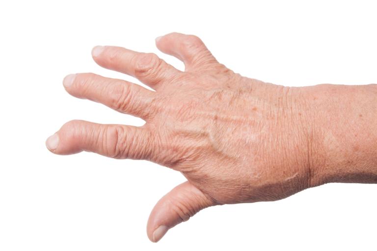 Hand,of,old,woman,deformed,from,rheumatoid,arthritis