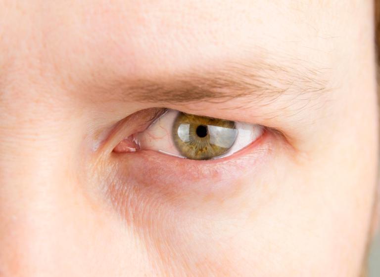 Detail,view,of,man,green,eye,with,heavy,upper,eyelid.