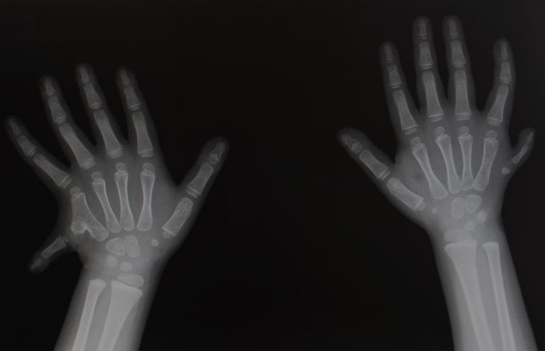 An,anteroposterior,radiograph,of,both,hands,showing,congenital,defect,of
