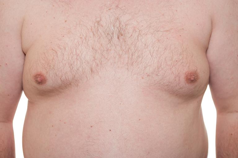 Male,thorax,showing,early,stage,gynecomastia,or,man,boobs,also
