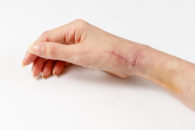 A,fresh,healing,scar,one,month,after,surgery,on,tendons