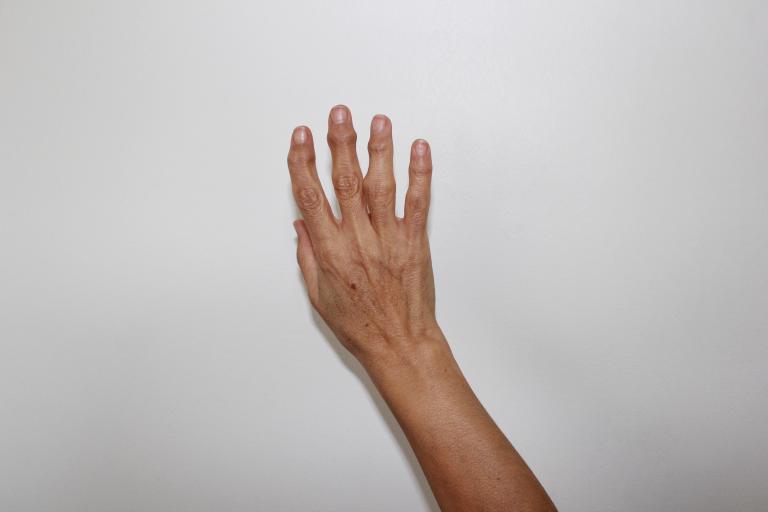 Old,woman,hands,with,rheumatoid,arthritis