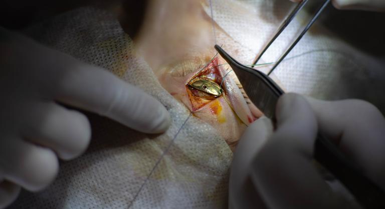 Unique,surgical,operation,for,neuritis,of,the,facial,nerve,,implantation