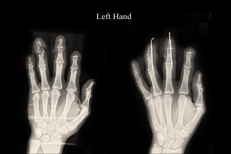 Fracture,middle,finger,and,ring,finger,left,hand
