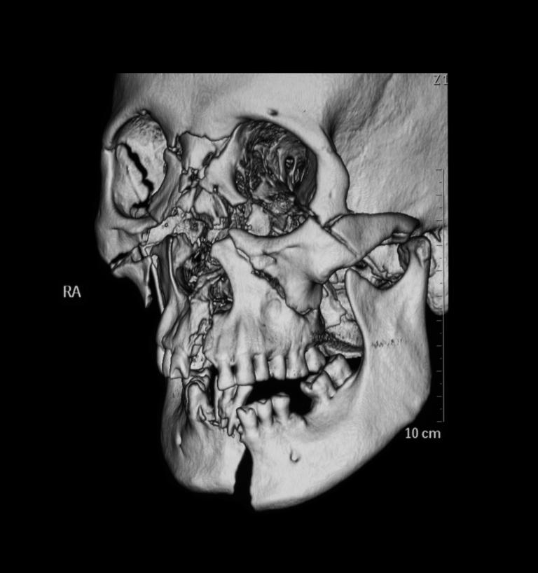 Computed,tomography(3d,ct,scan),of,facial,bone,without,intravenous,contrast